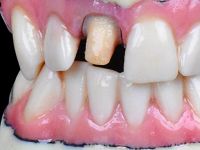 3-stratasysJ720-dental