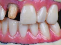 4-stratasysJ720-dental